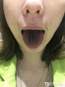 吃绿色瓜会使舌头变黑,揭秘吃后舌头变黑的科学真相